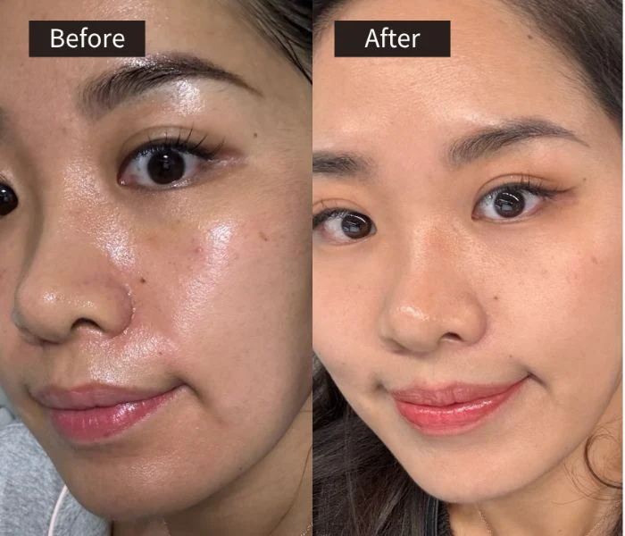 rejuran 1 tháng: dấu hiệu cải thiện sớm