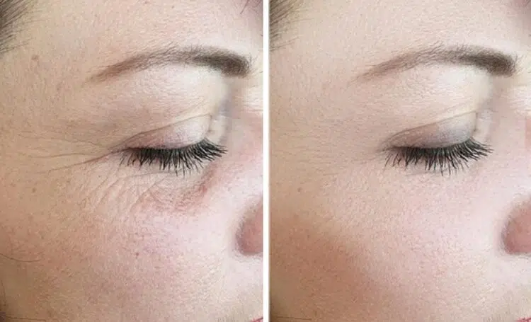 rejuran 6 tháng: hiệu quả ổn định và tối ưu