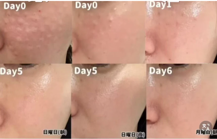 Có thể kết hợp Rejuran với liệu pháp khác không