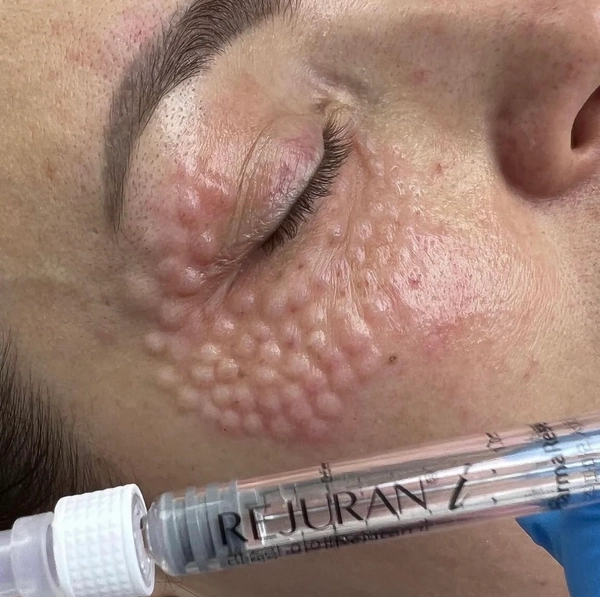 Sơ đồ tiêm rejuran có giống nhau cho mọi người không