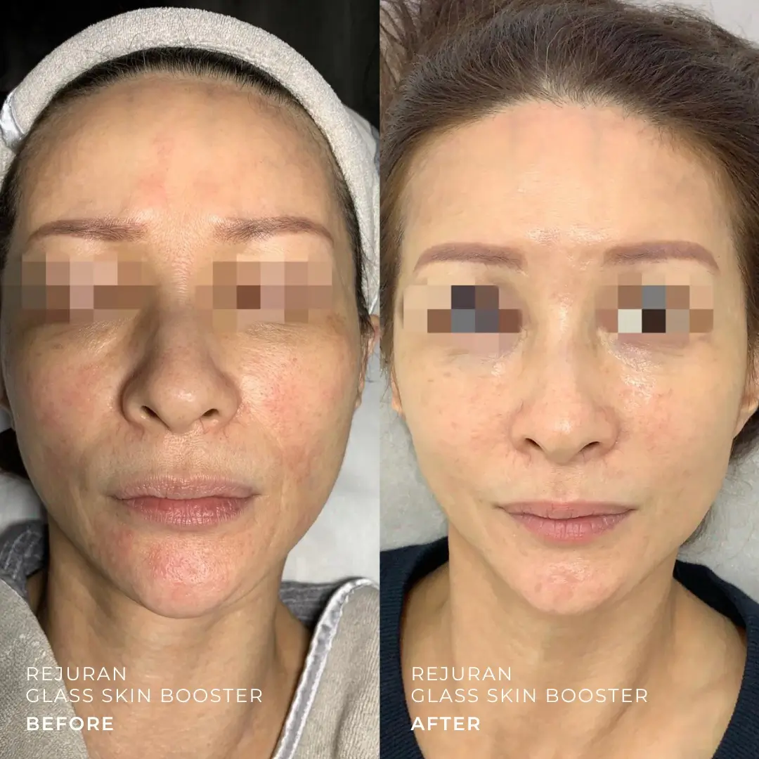 Ai không nên dùng Rejuran hoặc Profhilo