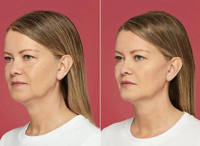 So sánh ngắn: restylane contour vs một vài filler khác