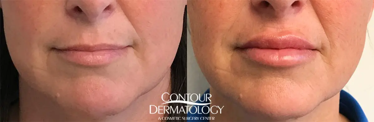 Chi phí và thời gian duy trì kết quả