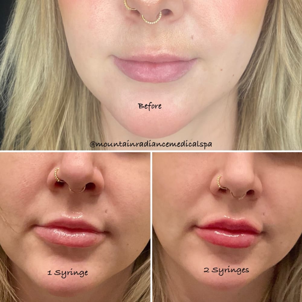 juvederm vs restylane: sự khác biệt về công nghệ