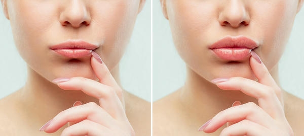 Rủi ro và cách hạn chế khi so sánh restylane juvederm