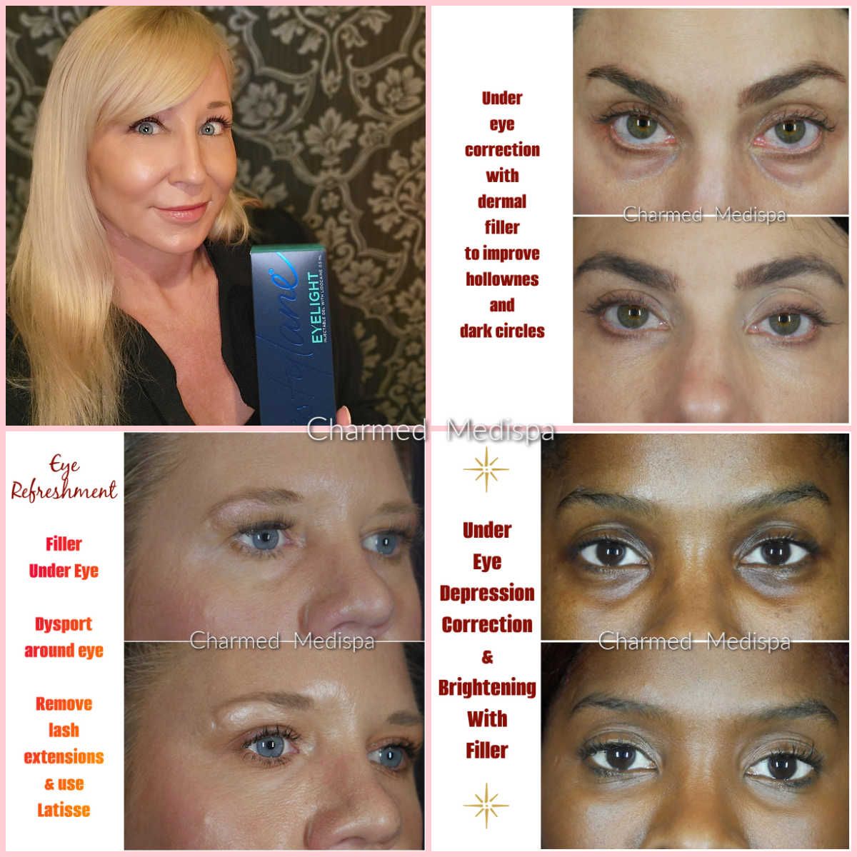 An toàn, tác dụng phụ và chống chỉ định khi dùng restylane trị quầng thâm