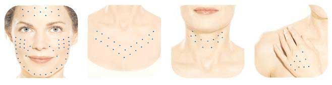 Gò má, cằm và hàm: sơ đồ tiêm restylane cho tỉ lệ khuôn mặt
