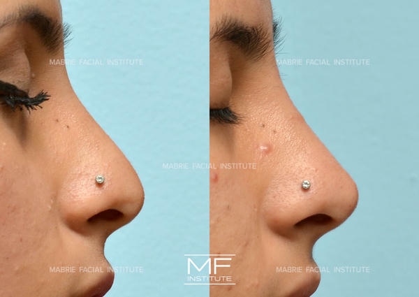 Nhược điểm và rủi ro khi dùng restylane nose filler