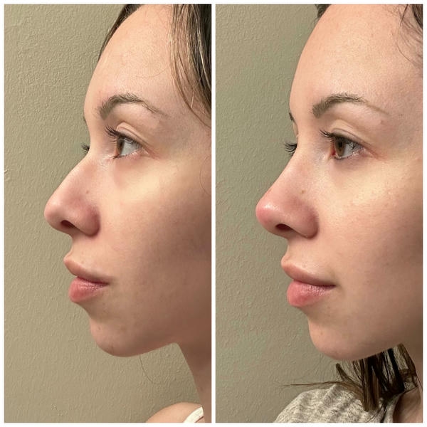 restylane nose review: Phản hồi thực tế từ người dùng