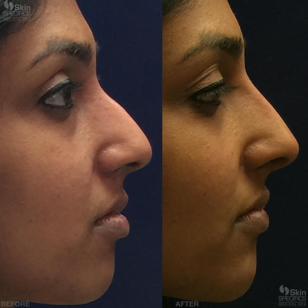 Hướng dẫn lựa chọn phòng khám và bác sĩ cho filler nâng mũi