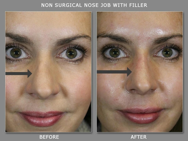 Ưu tiên an toàn khi cân nhắc restylane nâng mũi