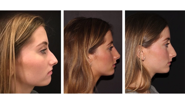 Nếu không ưng ý sau tiêm có tháo ra được không