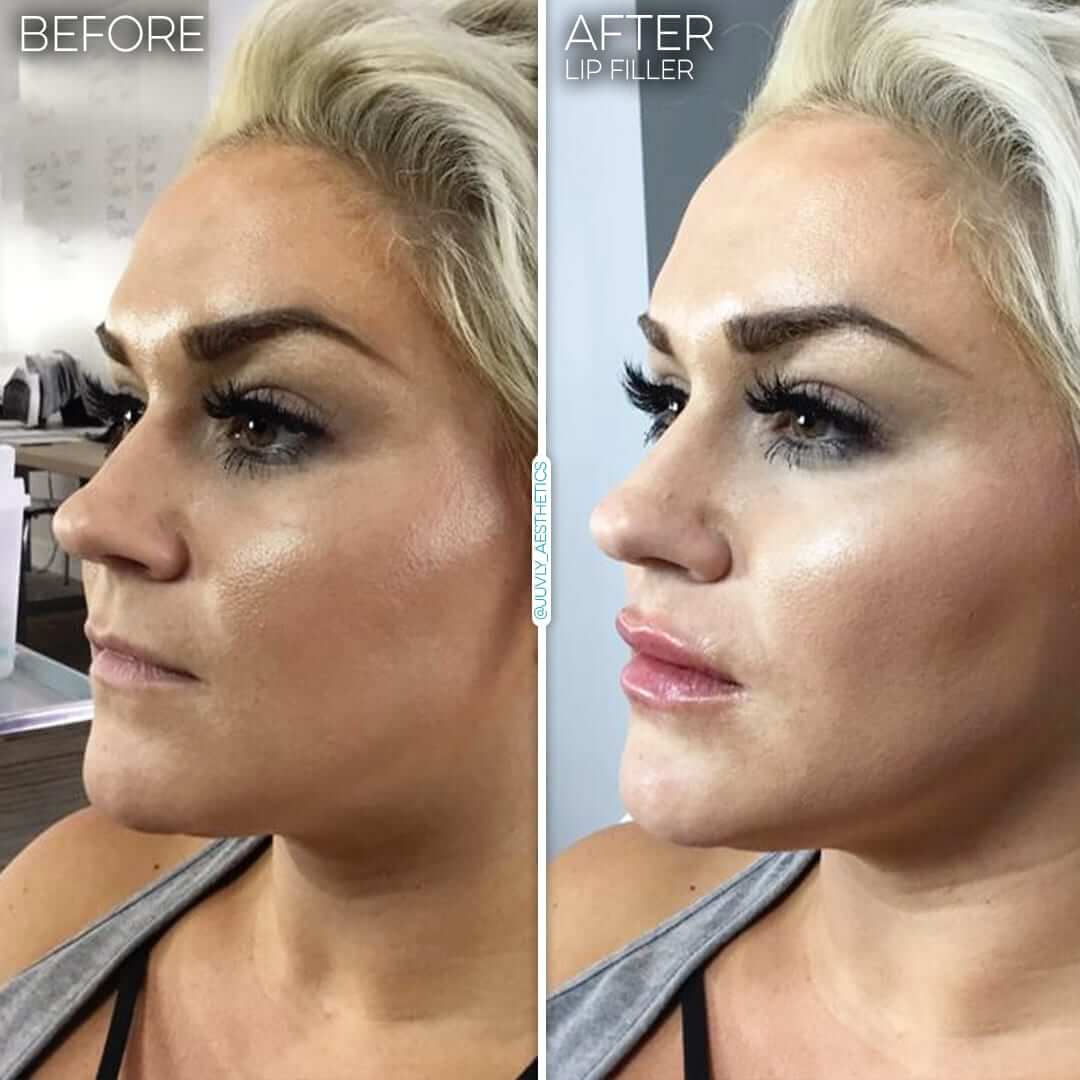 restylane silk giá: chi phí và các yếu tố ảnh hưởng