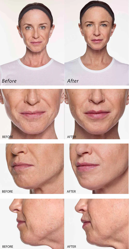 restylane silk review: trải nghiệm của khách hàng và bác sĩ