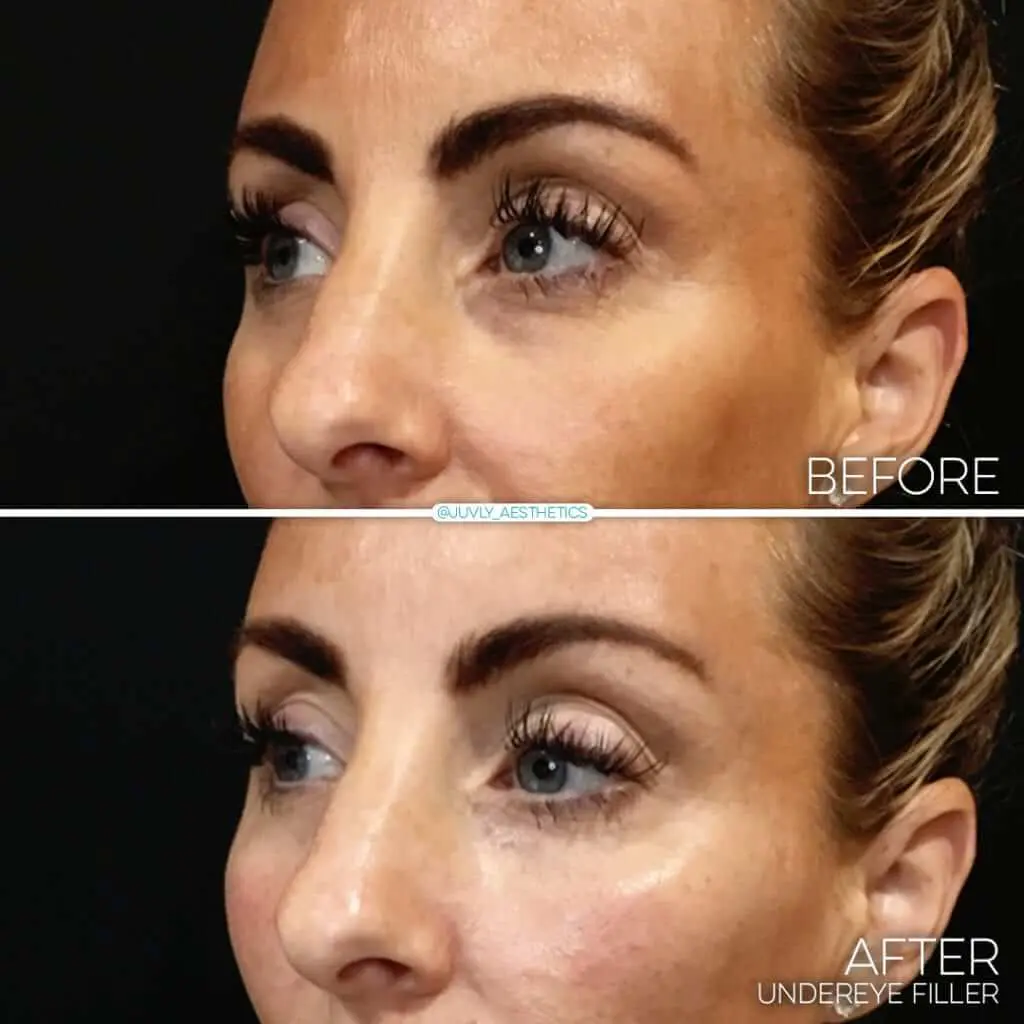 3. restylane silk giá thường là bao nhiêu