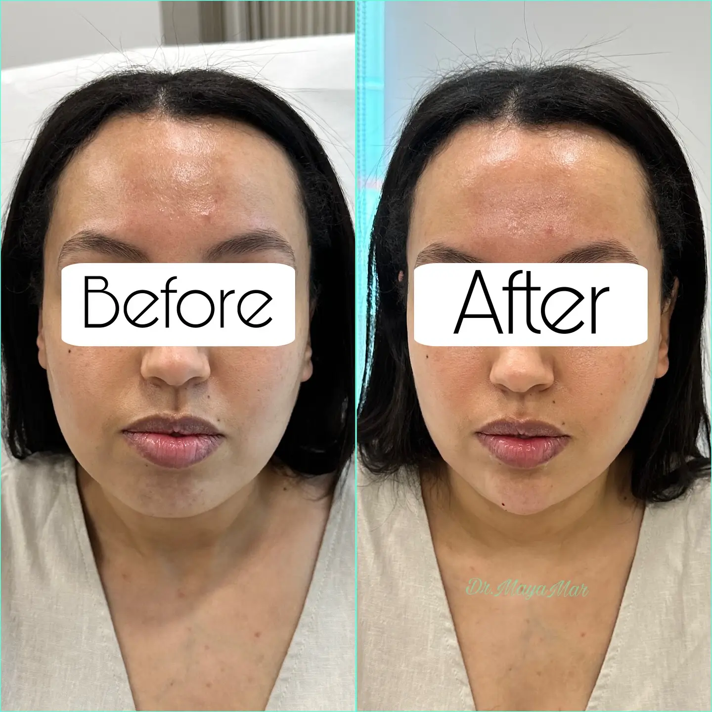 review neauvia hydro deluxe - trải nghiệm lâm sàng và khách hàng