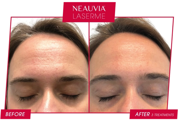 4. Khách hàng neauvia nên kỳ vọng gì về downtime