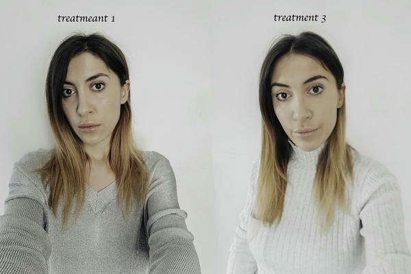 review restylane refyne: đặc điểm và cảm nhận sau tiêm