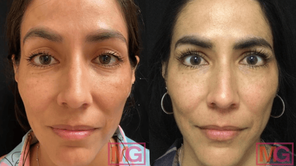 2. Hiệu quả kéo dài bao lâu