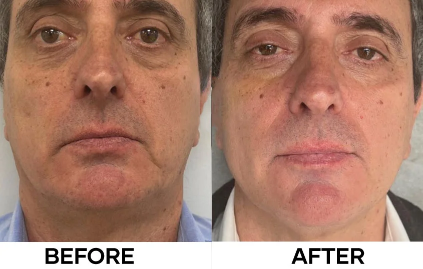 Kỹ thuật tiêm: bap technique, mesotherapy và microdroplet