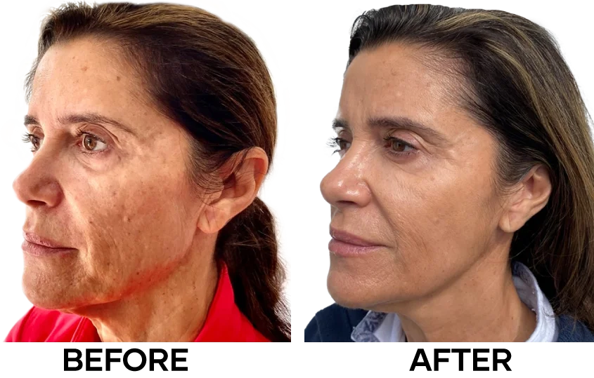 Ai nên chọn Revok50, ai nên chọn Redensity 1