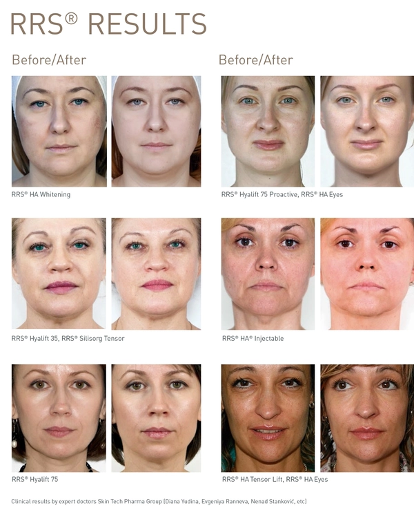 7. skinbooster vs meso — khác biệt chính