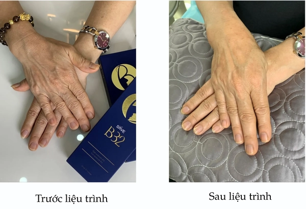 Chỉ định và kỹ thuật cho những vùng khó