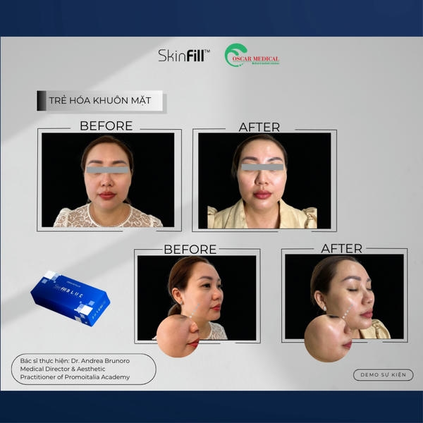 Tiêu chí đánh giá khi so sánh filler (filler so sánh)