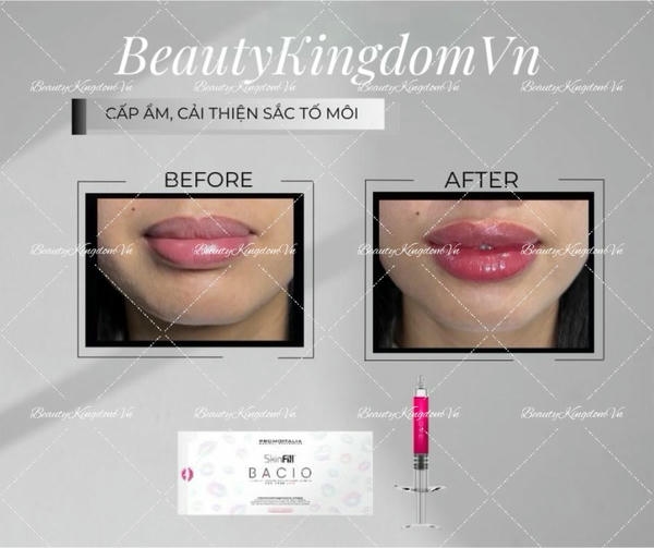 Skinfill: điểm mạnh và hạn chế