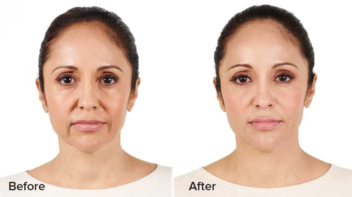 2. Filler juvederm duy trì được bao lâu