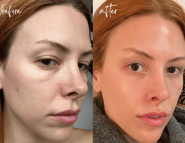 Khi nào nên chọn filler volumizer (SkinFill)