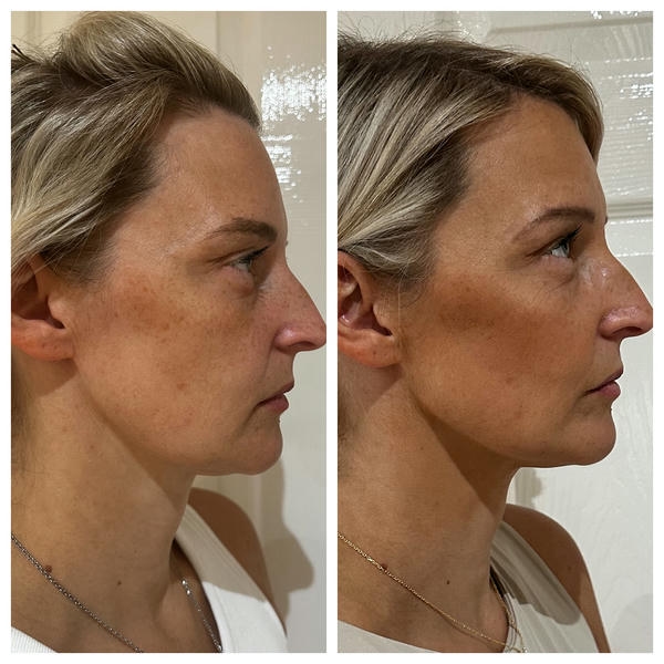 SRS vs Ejal40: so sánh hai skin booster/meso phổ biến