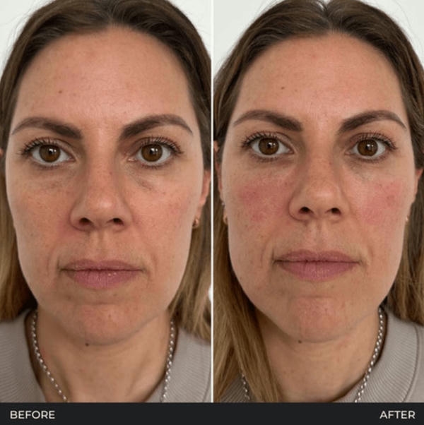 4. Bao lâu thì thấy cải thiện skin quality