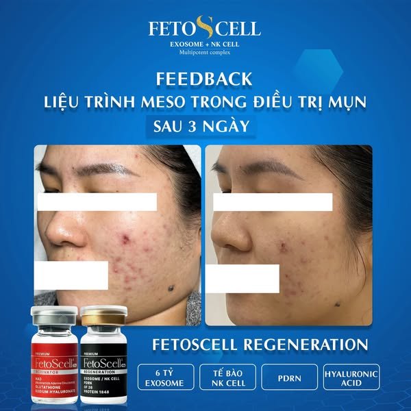 Ảnh thực tế: ảnh trước sau fetoscell và điều cần lưu ý