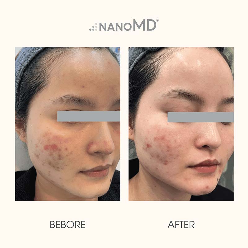 Ai phù hợp với fusion trị nám