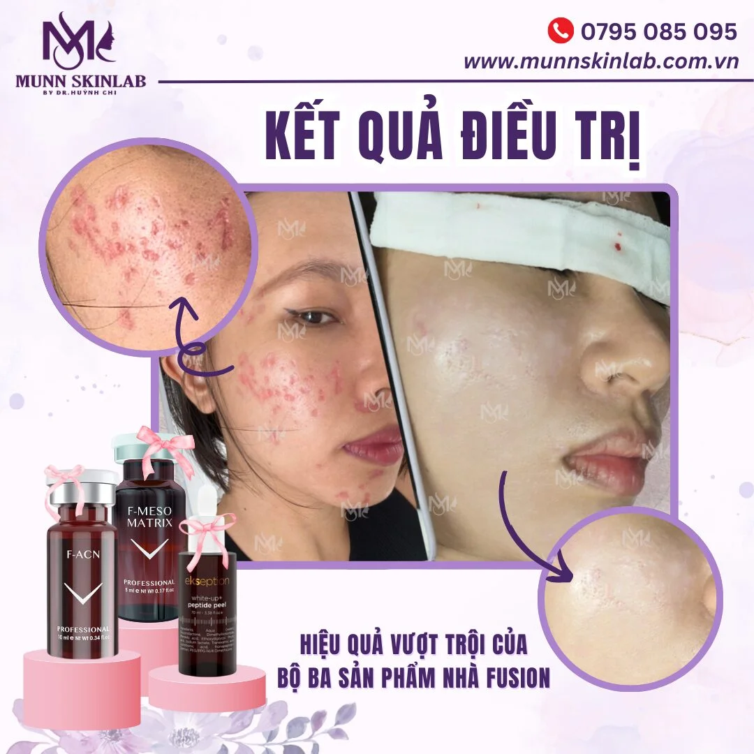 Ảnh trước sau fusion và cách đọc kết quả