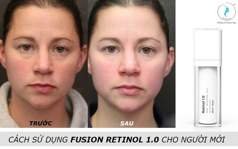 So sánh nhanh: ưu nhược điểm của fusion