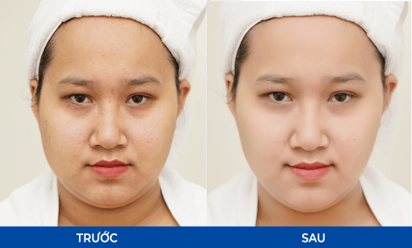 5. Làm sao để chọn bác sĩ tiêm hyacorp