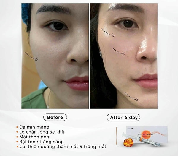 Ai phù hợp với liệu trình Amber trẻ hóa