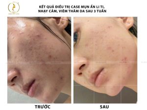 Quy trình chuẩn trước sau mccm tại phòng khám