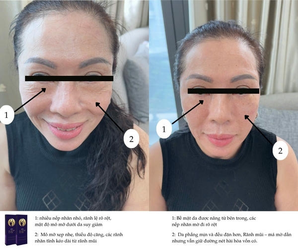 Những điểm quan sát trên ảnh trước sau Save B32