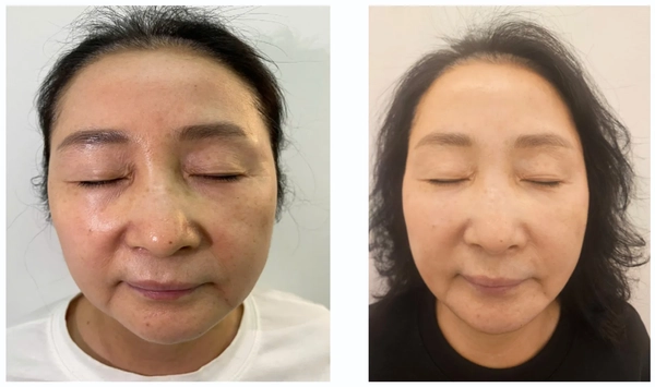 Quy trình thường gặp và thời gian thấy hiệu quả trẻ hóa