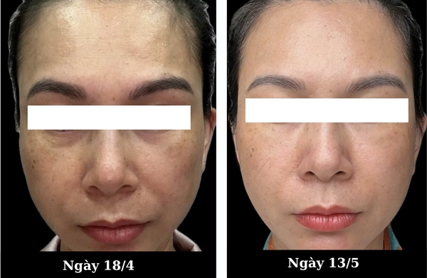 Những lưu ý an toàn khi quan sát ảnh trước sau Save B32