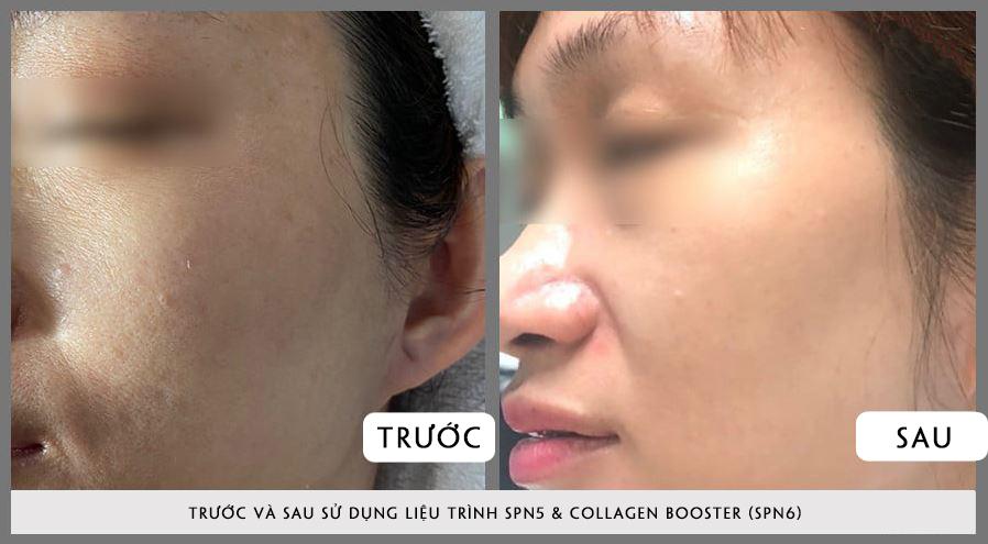 Quy trình điều trị trước sau srs: liệu trình và thời gian