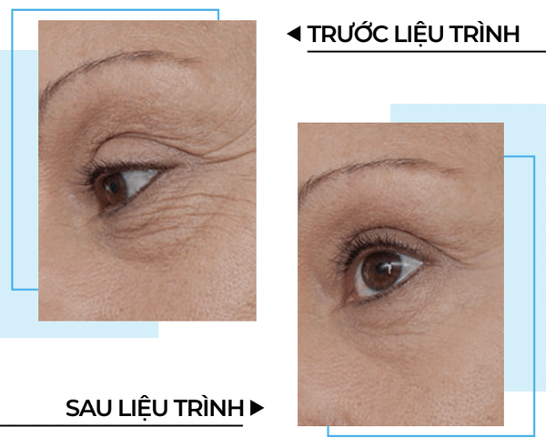 Filler môi: trước sau xcelens ở vùng môi