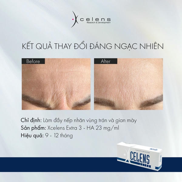 Bảng so sánh: trước sau xcelens theo vùng (mức chung tham khảo)