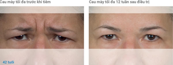 Trước sau Xeomin: những thay đổi thường gặp