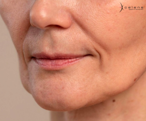 Tiêm filler xcelens: mẹo chọn bác sĩ và cơ sở