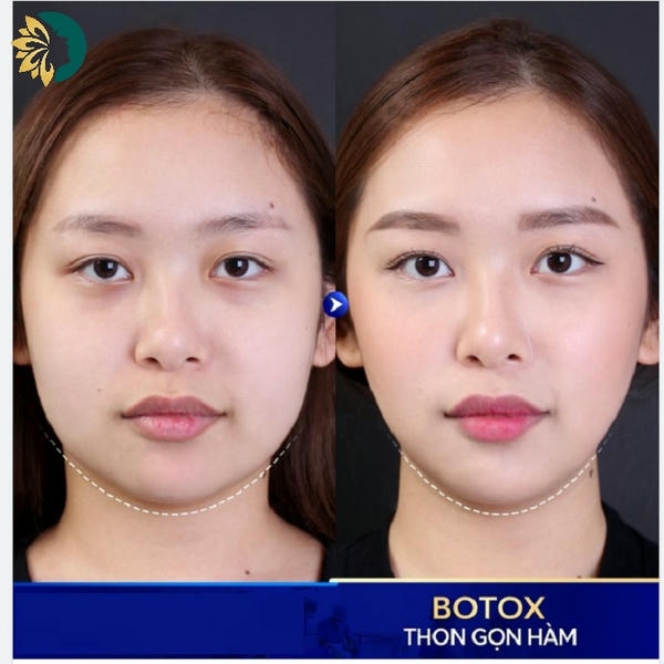 Sự khác biệt giữa Xeomin và các neuromodulator khác