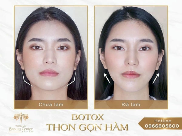 Kết quả dự kiến và lịch duy trì cho jaw reduction